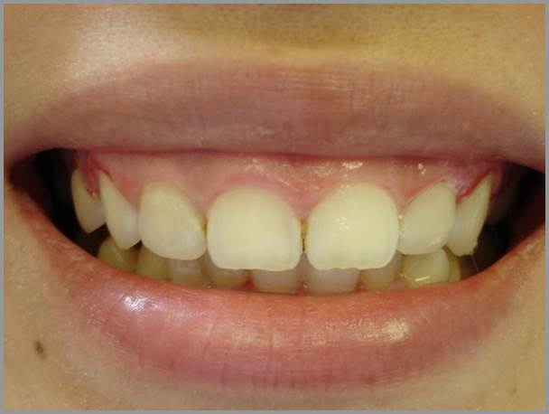 Gingival Recontouring Before
