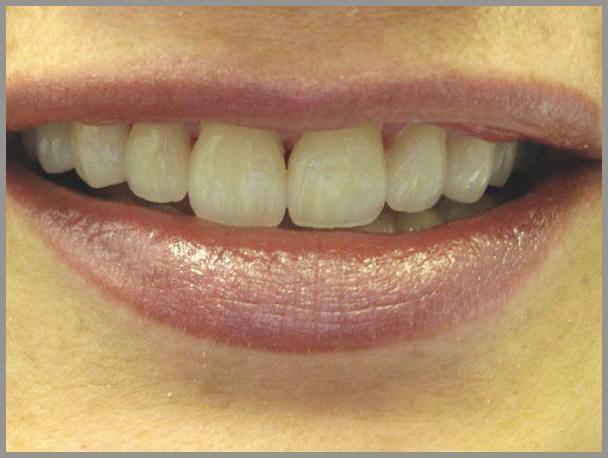 Worn and discolored Tooth After
