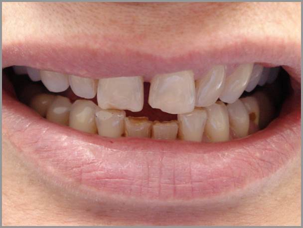 Worn and discolored Tooth Before