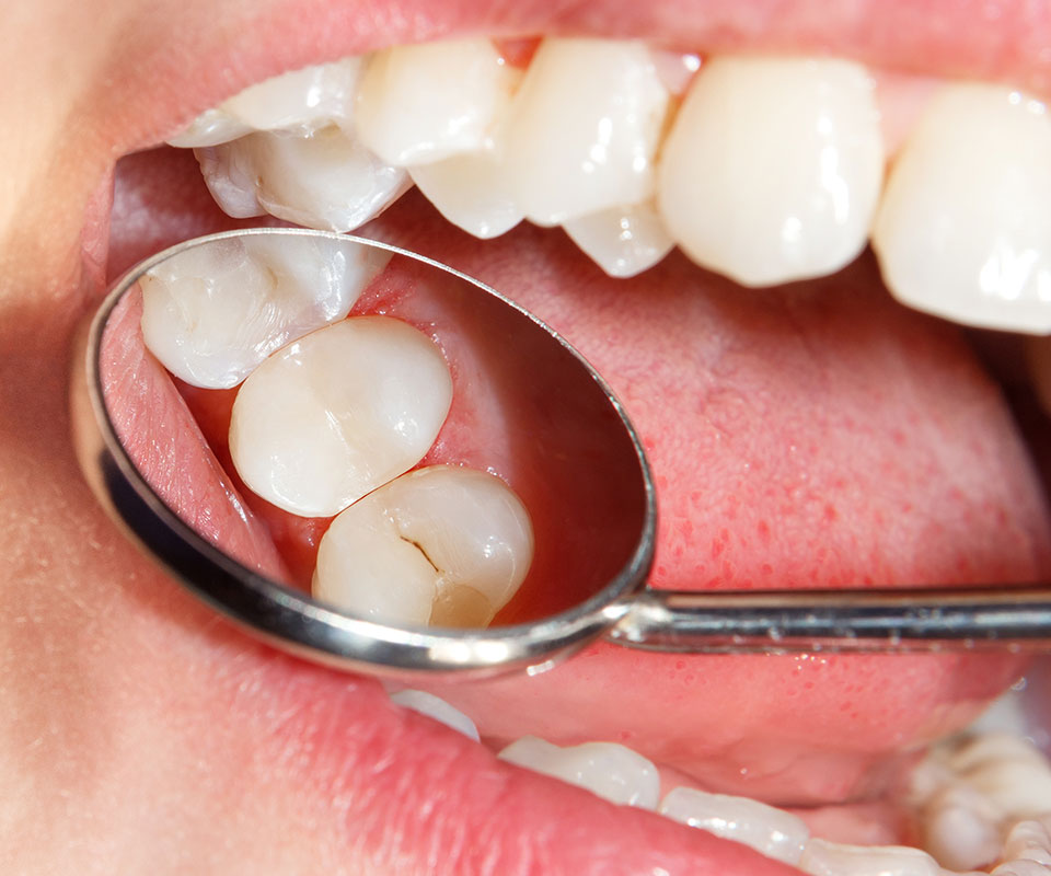 Composite Fillings 2