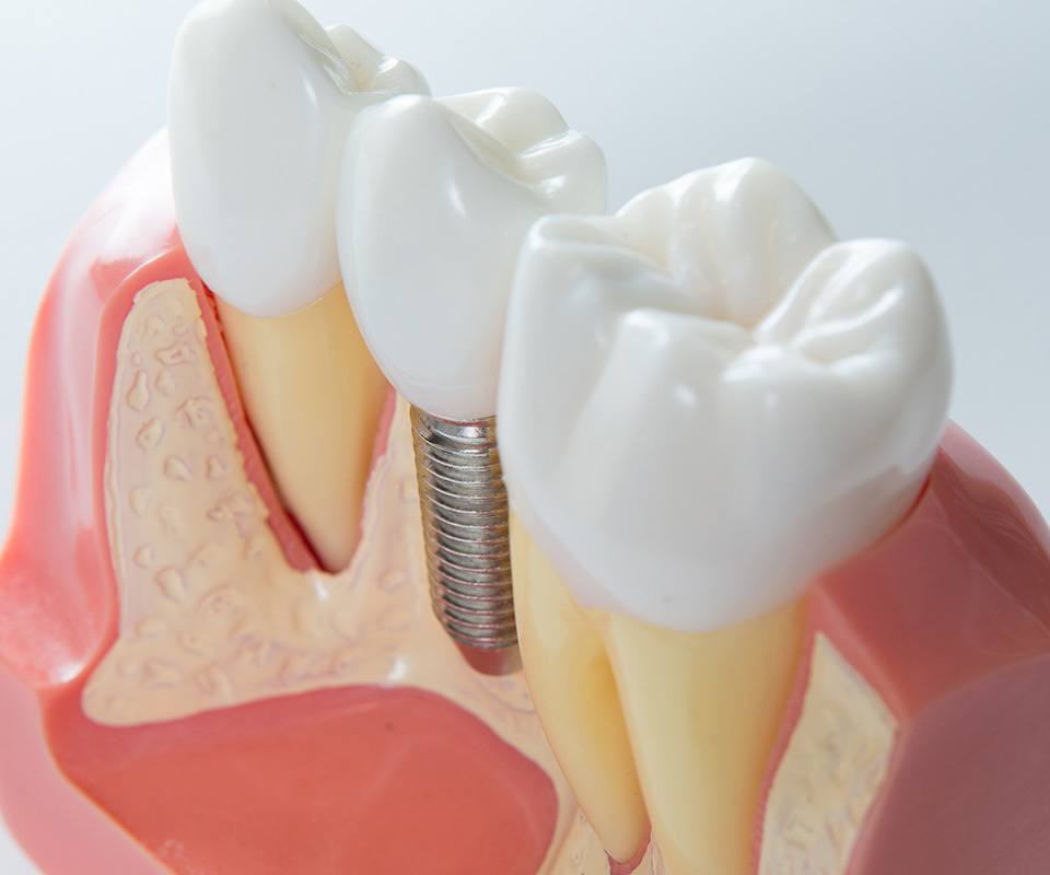 Dental Bridges in Toronto