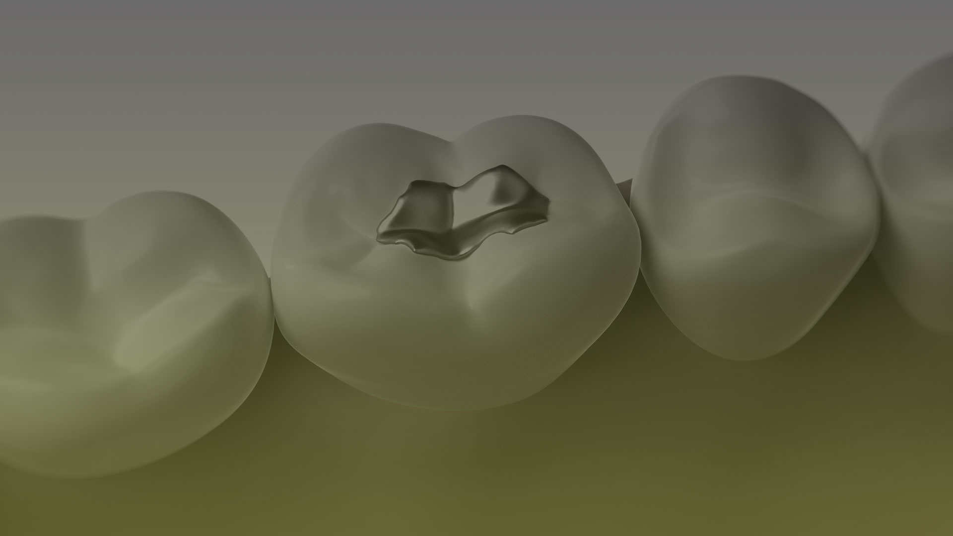 Amalgam Fillings