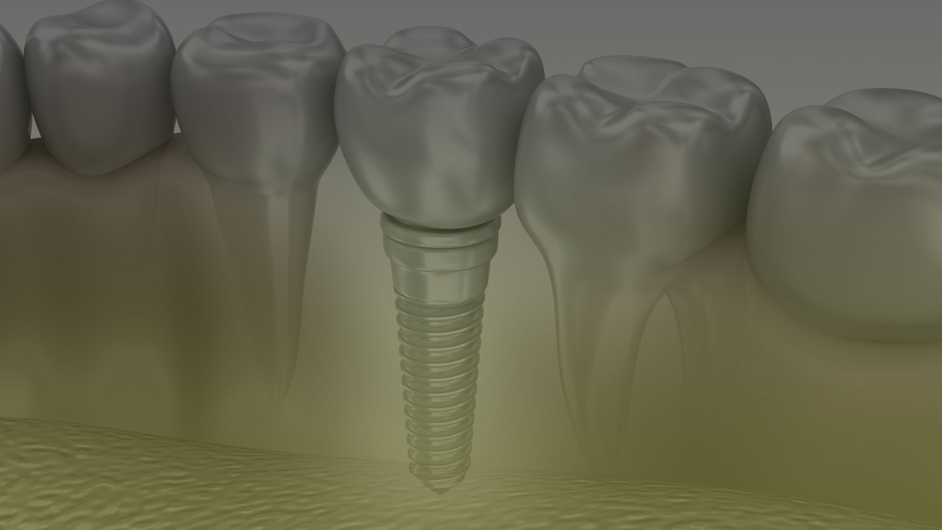 Dental Implants Procedure in Toronto