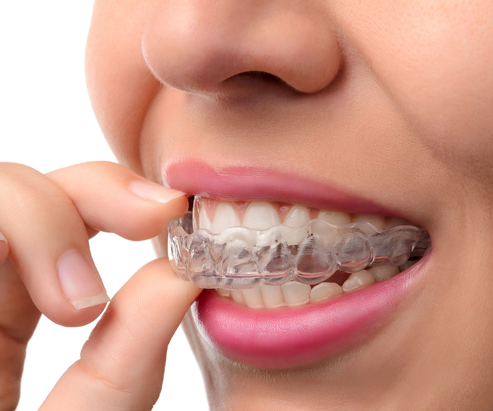 Invisalign Aligners Toronto