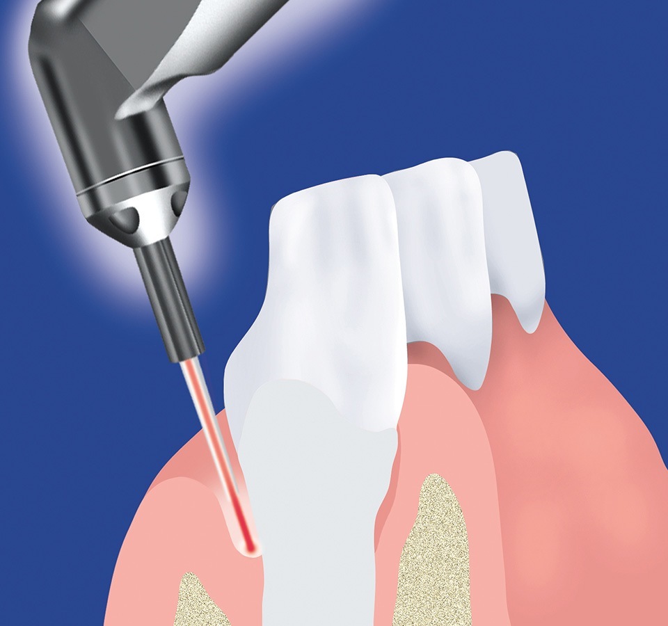 Laser Gum Disease Treatment in Toronto