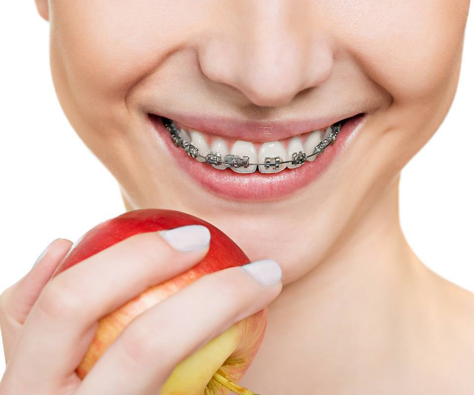 Dental Braces and Orthodontics in Toronto