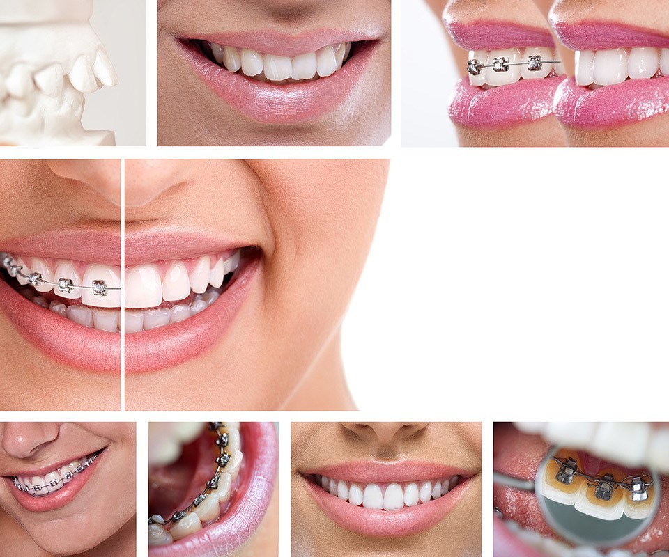 Orthodontic Appliances in Toronto