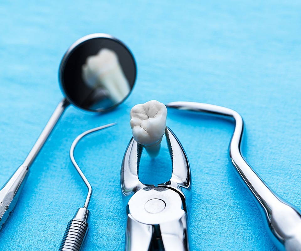 Tooth Extraction Toronto