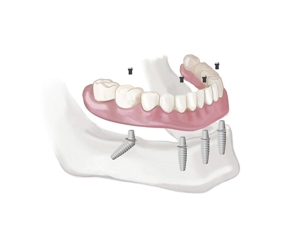 Dental Implants Procedure in Toronto