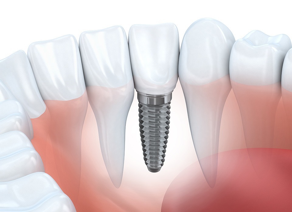 Dental Implants in Toronto