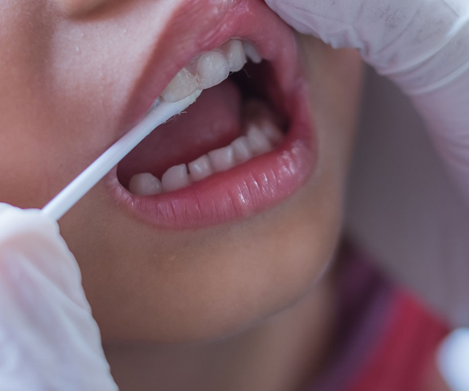 fluoride-treatment-toronto1