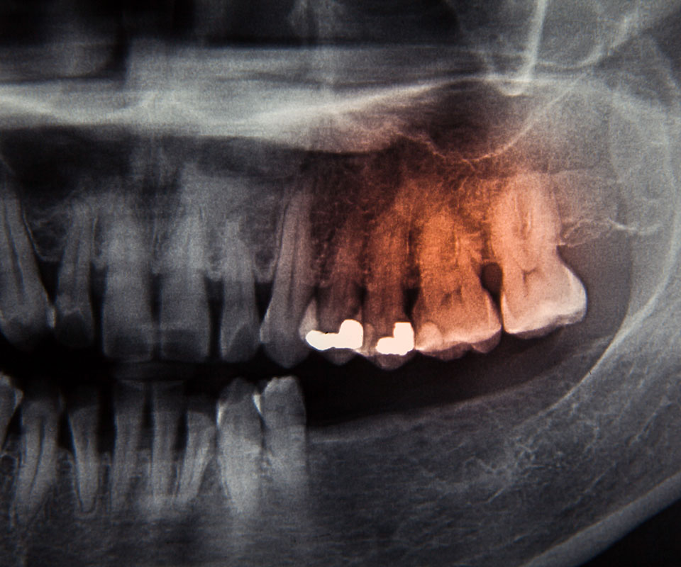 oral-cancer-sreening-toronto