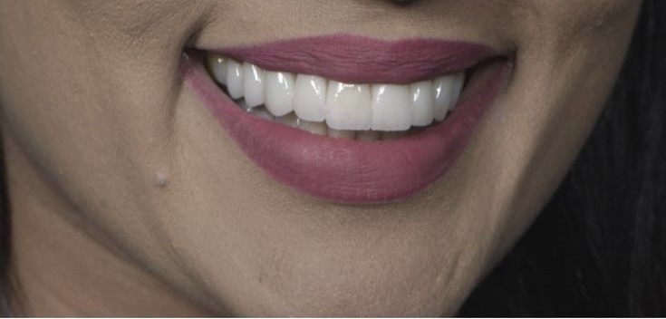 Veneers after