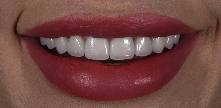 Veneers after