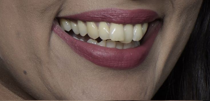 Veneers before