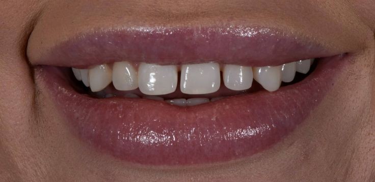 Veneers before