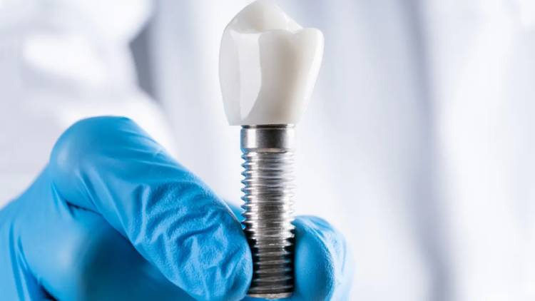 Best age for dental implants; all you need to know about 