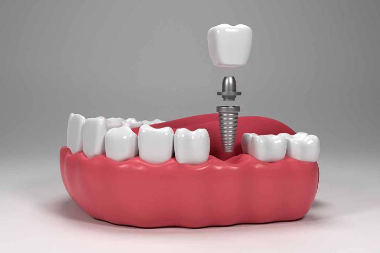 Everything about the best age for dental implants