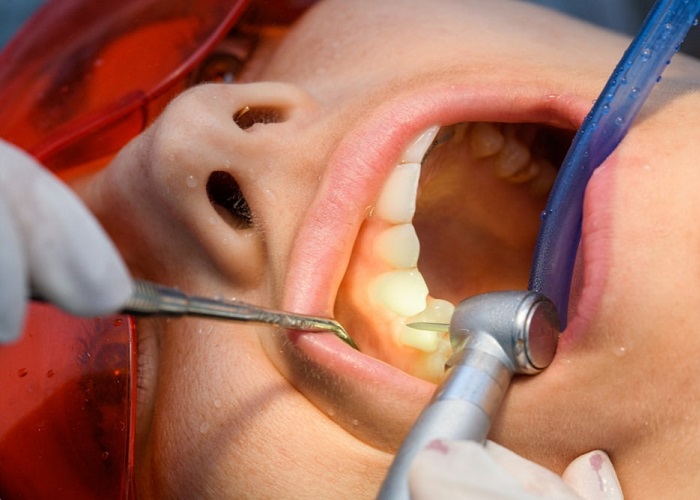 a dentist performing root canal retreatment