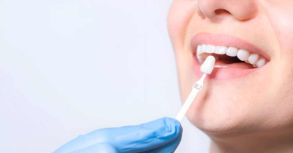 Porcelain Veneers in King West