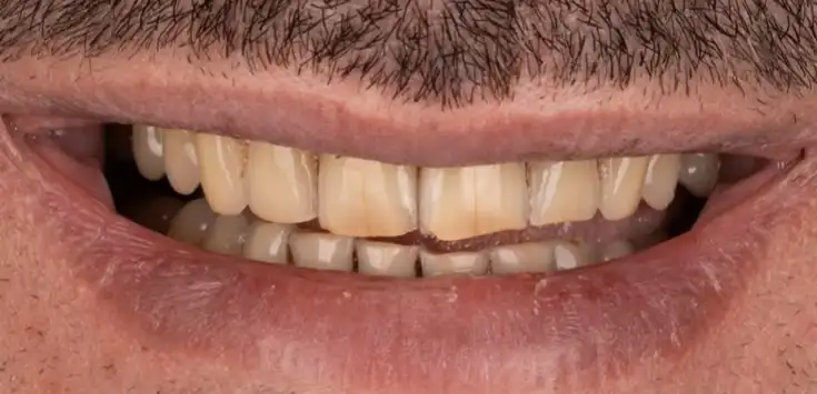 Before dental veneer