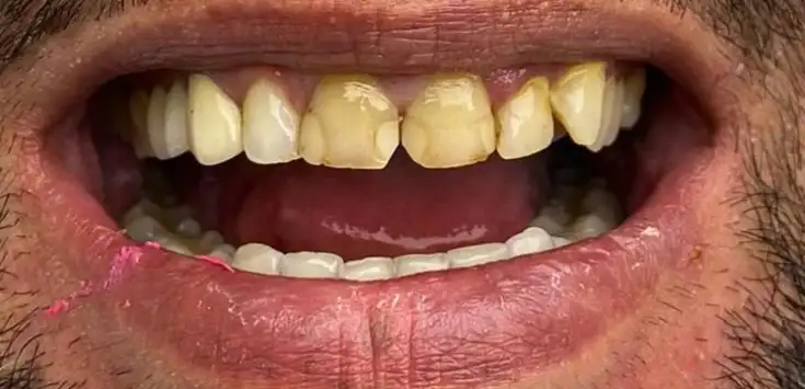 Before dental veneer