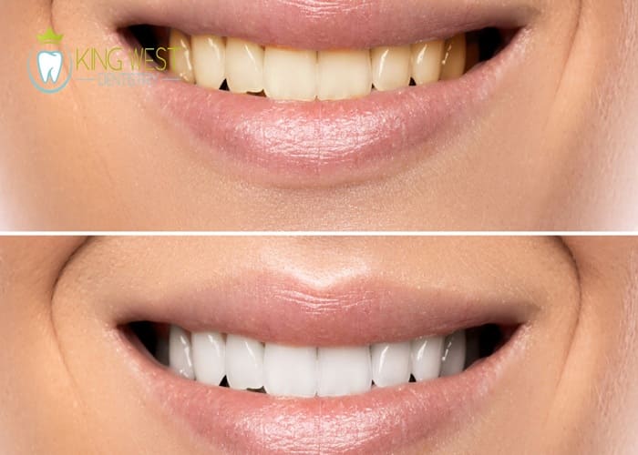 teeth whitening by Iranian dentist in Toronto
