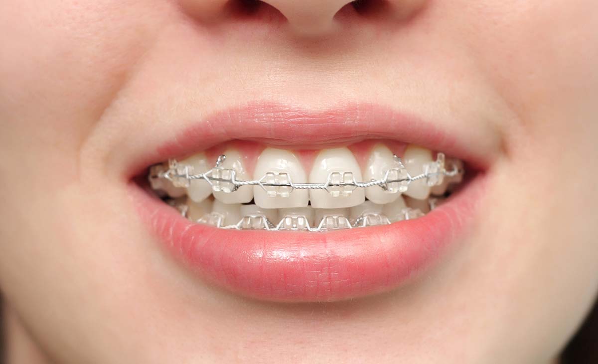 Ceramic braces close up