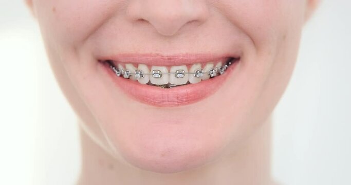 Metal braces close up