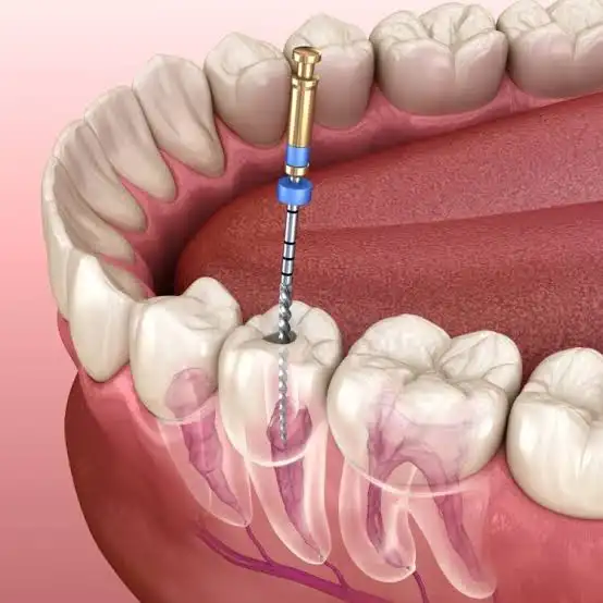 root canal kingwest