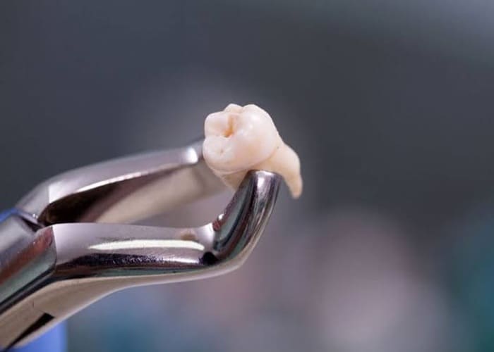 Wisdom Tooth Removal 