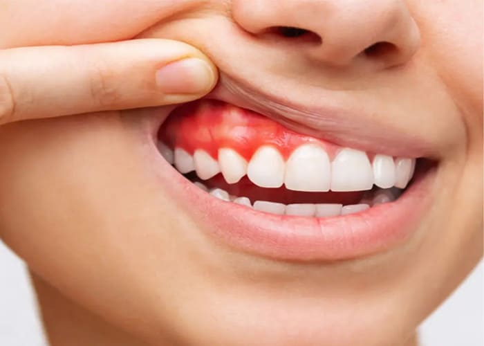 Red gums