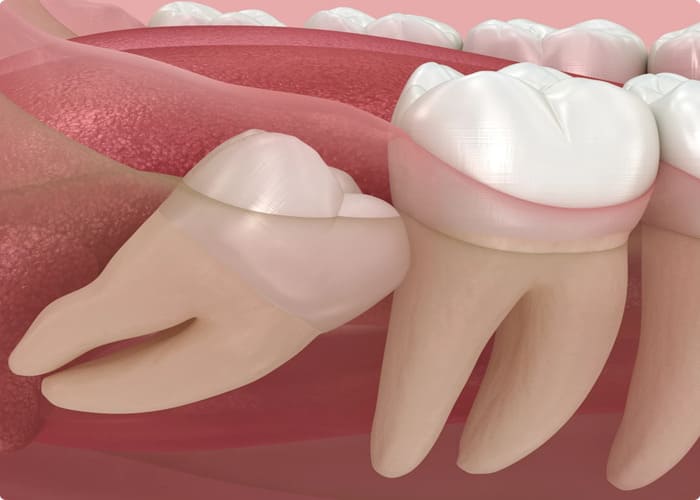 an Impacted Wisdom Tooth