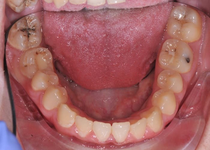 Changes in the Tooth Surface
