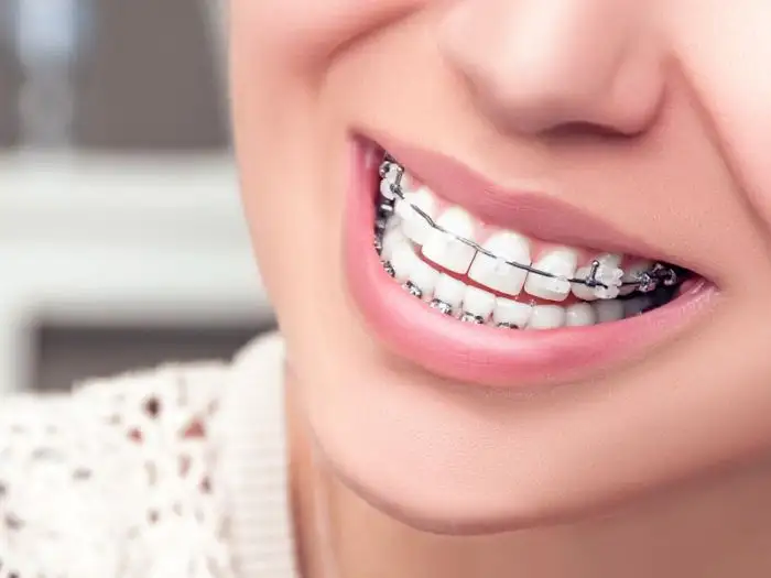 Why Choose Braces at King West Dentistry?