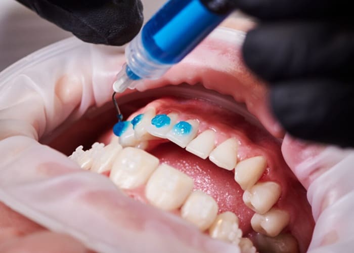 Fluoride Treatment