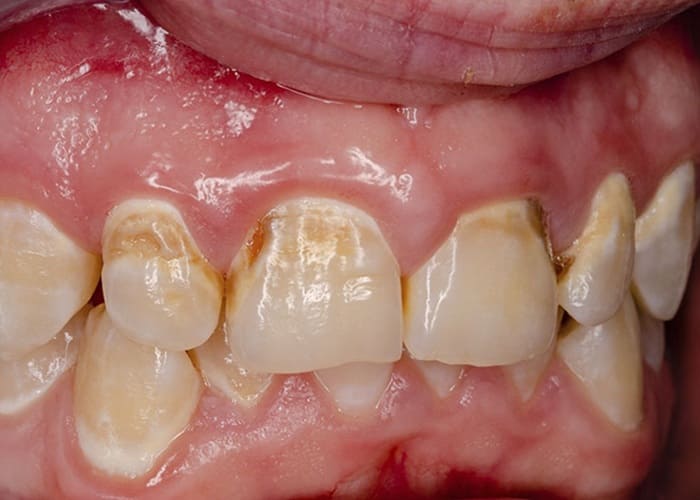 Spots on the Tooth