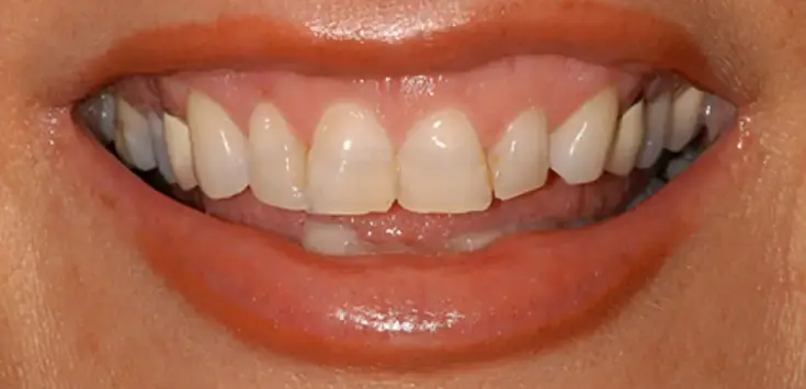 Before dental veneer