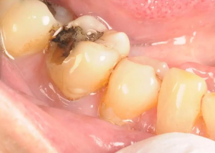 Cavity near the filling
