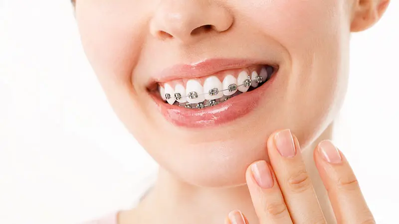 Dental Braces KING WEST