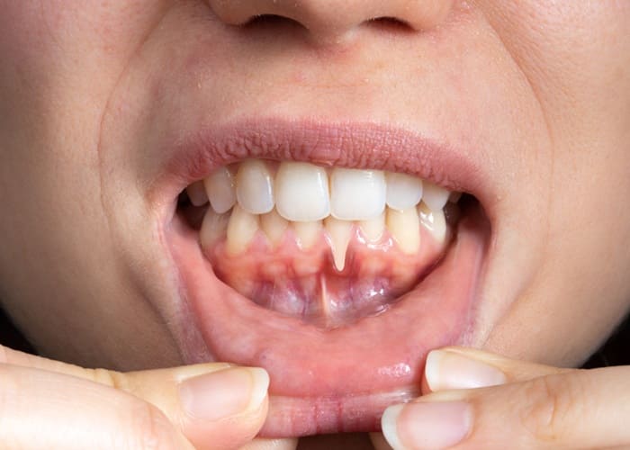 Gum disease 
