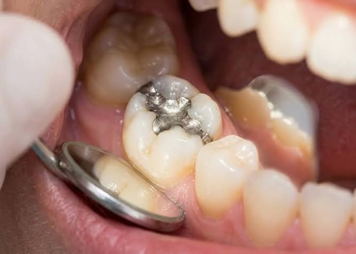 dental filling