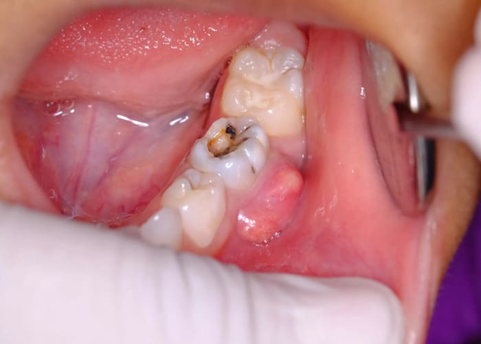Tooth root infection