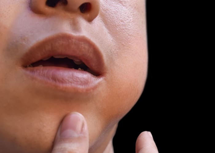 gum abscess