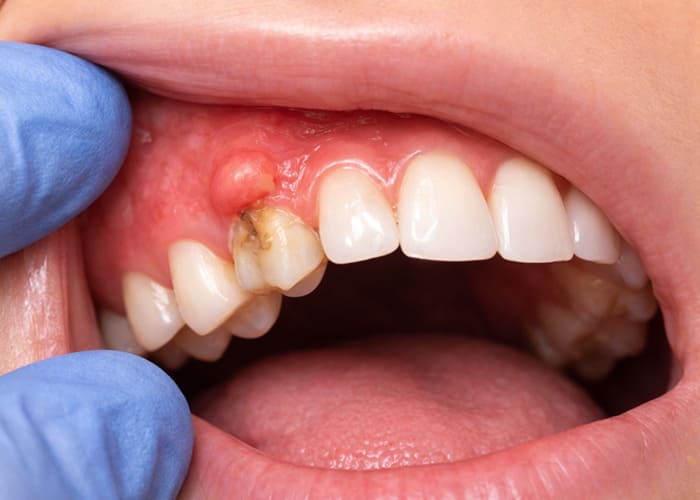 the reason of Gum Boil Keeps Coming