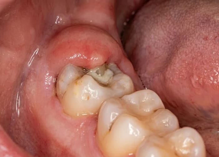 Partially impacted wisdom tooth